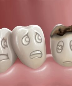 ¿Será posible eliminar las caries sin dolor?