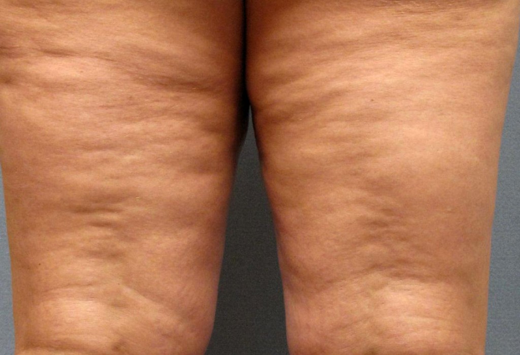 celulitis