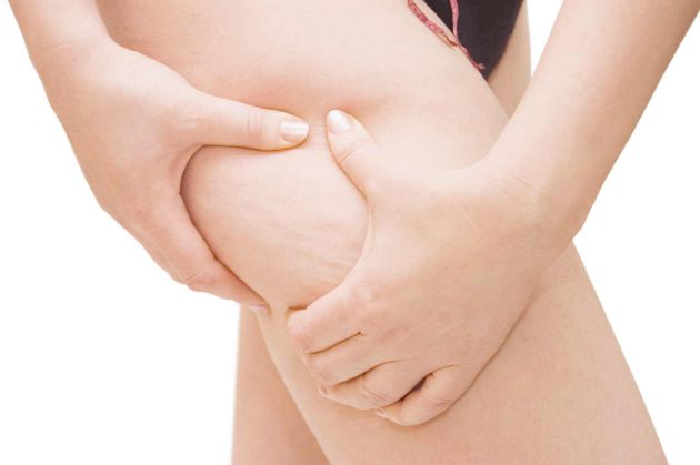 Cómo eliminar la celulitis fácilmente con ejercicios