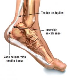 ¿Qué es la tendinitis aquílea?