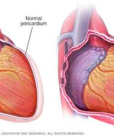 ¿Qué es la pericarditis aguda?