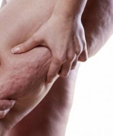Celulitis infecciosa: síntomas y cómo prevenir este problema