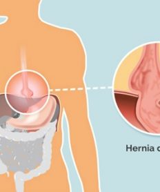 ¿Qué es la hernia de hiato?
