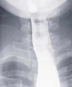 ¿Qué es la acalasia?